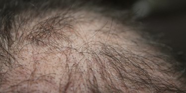 Close up of scalp suffering from hair loss