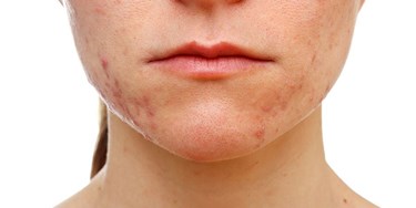 Close up of woman's face with acne